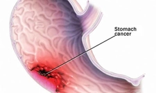 Mide Kanseri Metastaz Belirtileri ve Tedavisi