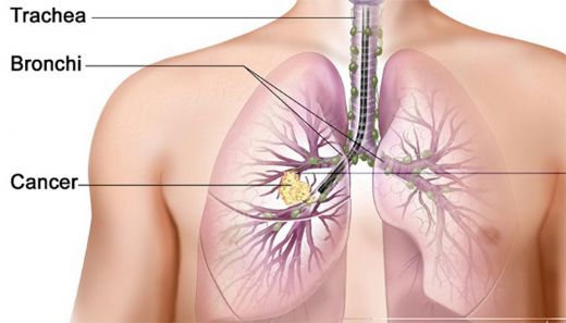 Akciğer Kanseri Beyin Metastazı