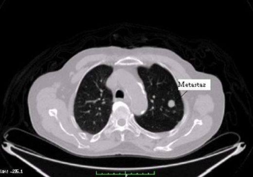 Akciğere Metastaz Yapan Tümörler