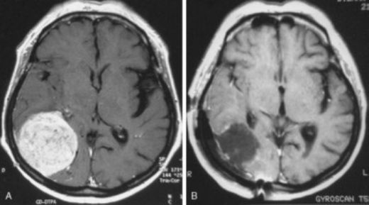 Beyin Metastazı Evreleri Nelerdir?