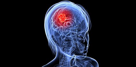 Beyin Metastazı Nedir?