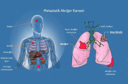 Karaciğer Metastazı Belirtileri ve Tedavisi