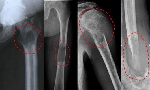 Kemik Metastaz Belirtileri Nelerdir?