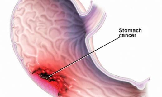 Mide Kanseri Beyin Metastazı
